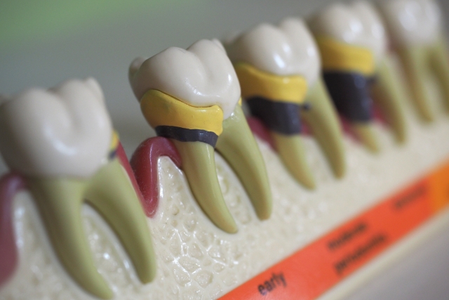 横浜市西区（平沼橋）の歯医者の歯ぎしり対策